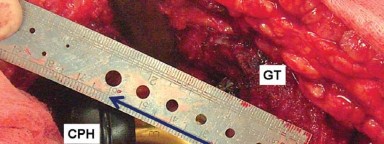 صورة طبية: إتقان توازن الأنسجة الرخوة لمفصل ورك صناعي مثالي: دليل شامل للمرضى مع الأستاذ الدكتور محمد هطيف