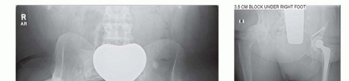 Illustration 14 for Special THA Techniques for Severe Deformities Around the Hip