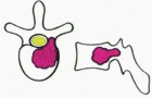 Illustration 8 for Total En Bloc Spondylectomy: Complete Resection for Spinal Tumors