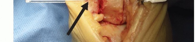 Talus Anterior Tibial Osteotomy: Achieve Stable Healing