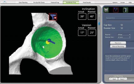 Illustration 33 for Robotics in Total Hip Arthroplasty: A New Era of Precision