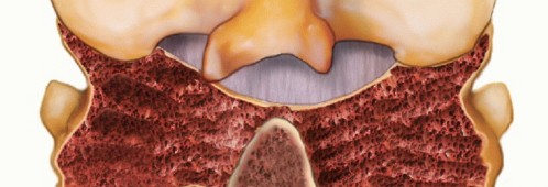 Illustration 3 for Achieve Stability: Posterior Cervical Lateral Mass Screw Fusion