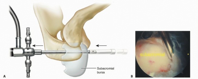 Illustration 18 for Stiff Shoulder? Discover Arthroscopic Capsular Release Solutions
