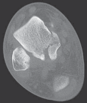 Illustration 30 for Talar Neck Fracture Treatment: Optimizing Recovery with ORIF