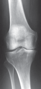 Illustration of knee arthroplasty unicondylar - Dr. Mohammed Hutaif