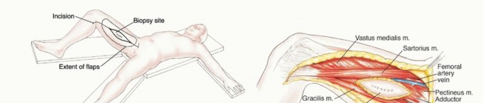 Illustration 7 for Optimizing Adductor Muscle Group Resection for Limb Preservation