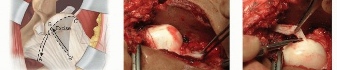 Illustration 17 for Mastering Anterior Open Reduction for Developmentally Dislocated Hip