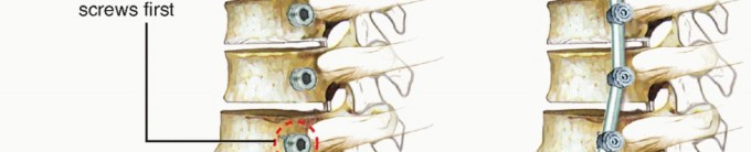 Illustration 11 for Anterior Thoracic Corpectomy: Decompression, Stabilization, Fusion