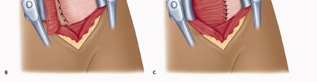 Illustration 29 for Mastering the Treatment of Recurrent Posterior Shoulder Instability