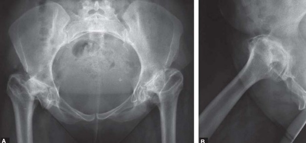 Illustration 151 for Successful Total Hip Replacement in Developmental Dysplasia
