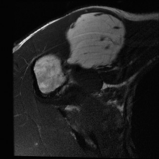 Illustration of atypical lipomatous tumor - Dr. Mohammed Hutaif
