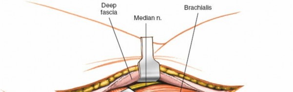 Illustration 35 for Mastering Elbow Approaches: Applied Surgical Anatomy for Precision