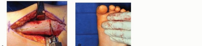 Illustration 13 for Distal Tibial Osteotomy: Fixing Varus & Valgus Ankle Alignment