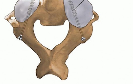 Illustration 20 for Master Techniques for Cervical Fracture Reduction: Type III & More