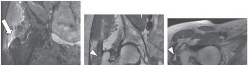 Illustration 56 for Periarticular Arthroscopy: Addressing Medius & Minimus Tears