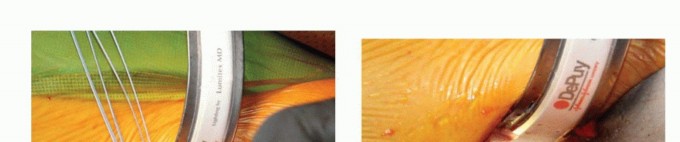 Illustration 35 for Anterior FAI Relief: Mini-Open Anterior Approach Explained