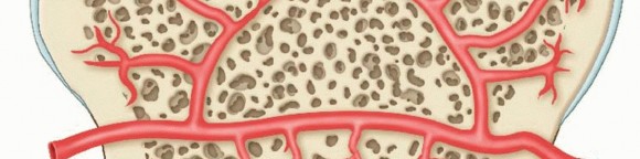 Illustration 10 for Dissecans of the Knee: What's the Difference – OCD vs. AVN?
