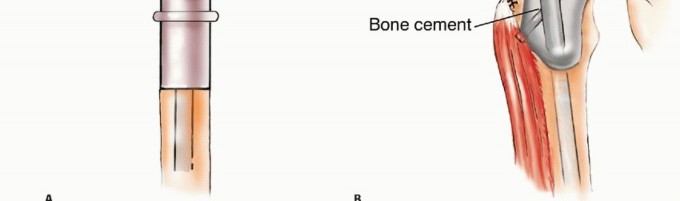 Illustration 23 for Mastering Femoral Metastases: Optimal Function for Femoris & Vastus
