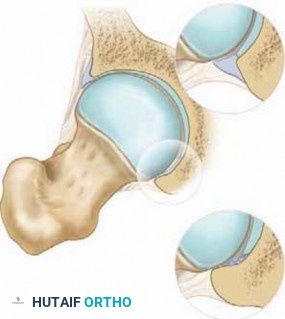 Illustration 3 for Solving Hip Soft Tissue Pathology with Advanced Arthroscopy
