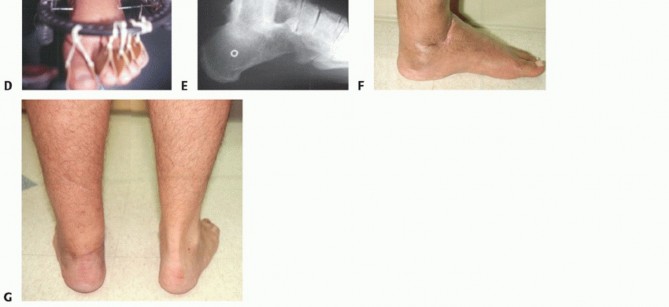 Illustration 29 for Beyond Amputation: Circular Fixation for Infection of the Talus