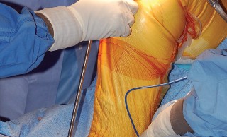 Illustration 22 for Mastering Gap Balancing in Revision TKA: Avoid Common Pitfalls