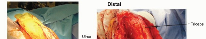 Illustration 13 for Surgical Approaches to Shoulder & Elbow: Pearls and Pitfalls