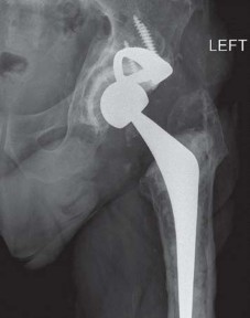 Illustration 10 for Expert Bone Grafting for Primary Total Hip Replacement Success