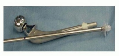 Illustration 17 for Cemented Total Hip: A Successful & Evidence-Based Solution