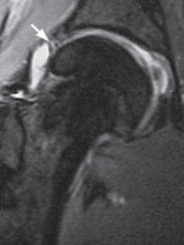 Illustration 30 for Solving Hip Soft Tissue Pathology with Advanced Arthroscopy