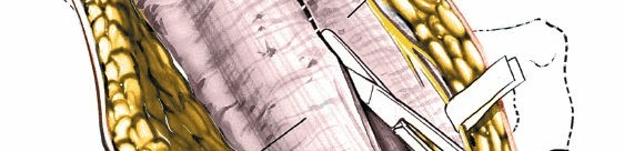 Illustration 32 for Unlocking Every Aspect of the Hip's Surgical Approaches