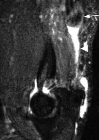 Illustration 2 for Elbow Pop & Pain? What a Triceps Tendon Rupture Means