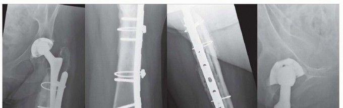 Illustration 31 for Mastering Fixation of Periprosthetic Fractures of the Femur