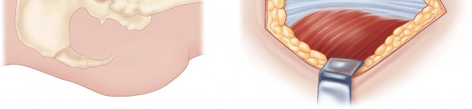 Illustration 21 for Figure Hip Resurfacing: Who Benefits and Who Should Avoid It?