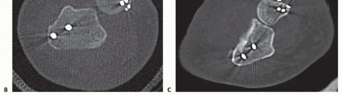 Illustration 8 for Galeazzi DRUJ Stabilization: Unlocking Stability with Smooth Stainless Steel