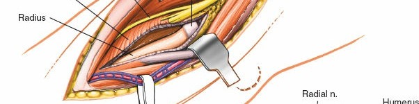 Illustration 65 for Mastering Elbow Approaches: Applied Surgical Anatomy for Precision