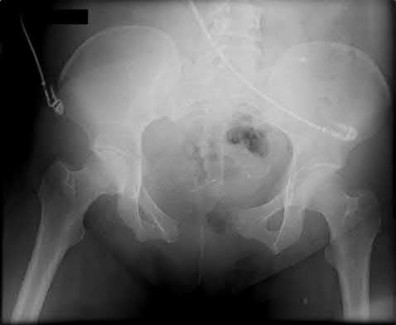 Illustration 126 for OrthoCash: Trauma MCQs & Cases for a yearold woman