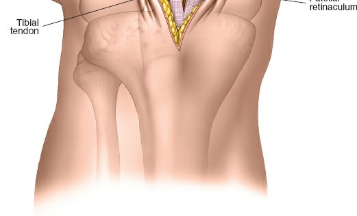 Illustration 80 for Optimal Femoral Approaches: Mastering the Lateral Intermuscular Septum