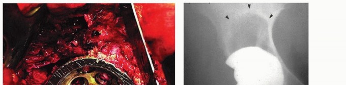 Illustration 3 for Osteolysis Solved: Polyethylene Liner Exchange for Well-Fixed Components