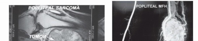 Illustration 3 for Complex Popliteal Resections: Protecting the Greater Saphenous Vein