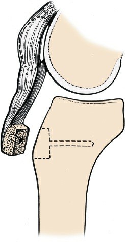 Illustration 44 for Mastering Knee Approaches: Spotlight on Superficial Medial Ligament