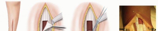 Lengthening of Gastrocnemius: Fix Equinus & Boost Mobility