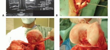 Illustration 7 for Expandable Prostheses: Understanding Infection Risk for Young Patients