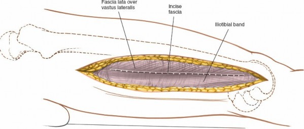 Illustration 18 for Optimal Femoral Approaches: Mastering the Lateral Intermuscular Septum