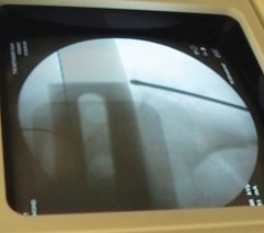 Illustration 14 for Arthrodesis with an Intramedullary Nail: Fixing Failed TKAs