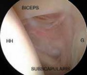 Illustration 17 for Capsular Releases for Loss of Motion: Restore Your Shoulder