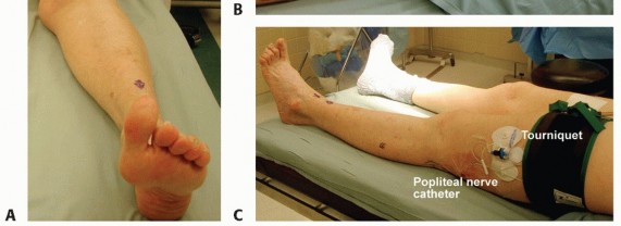 Illustration 6 for Lateral Column Lengthening: Relieve Flatfoot Pain & Correct Deformity
