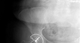 Illustration 12 for Mastering Direct Anterior Approach Hip Arthroplasty Without a Traction Table