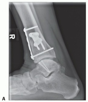 Illustration 47 for Unlock Healing: Medial Malleolar Osteotomy for Talus OLT Allografts