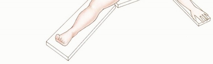 Illustration 14 for Mastering Above-Knee Amputation: Essential Surgical Insights