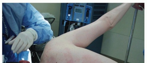 Illustration 7 for End CN XI Palsy Pain: The Eden-Lange Procedure Solution